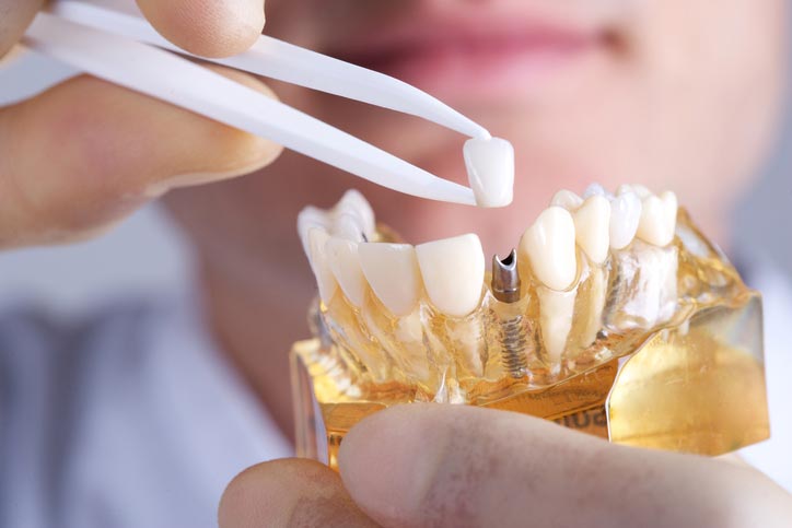 Dental Implant Services in Sioux Falls